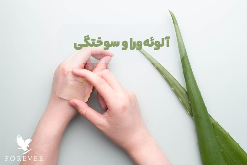 ژل آلوئه ورا برای سوختگی: معجزه ای گیاهی!